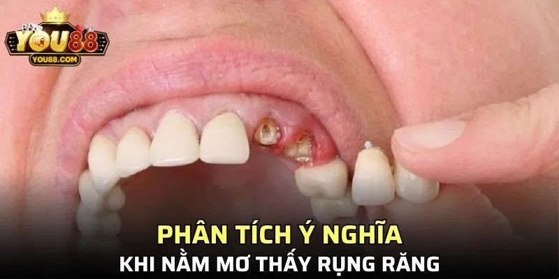 Phân tích ý nghĩa của giấc mơ rụng răng